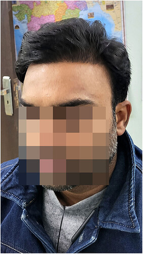 After 1 years hair transplant result update at the hairsmith clinic delhi india (4)