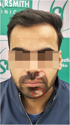 Before - HS 817 - The Hairsmith Clinic Delhi India - 1