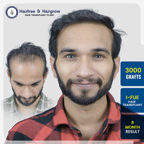 ramesh-pangaonkar-3000-grafts-i-fue-hair-transplant-8-month-result-norwood-grade-pune.jpg