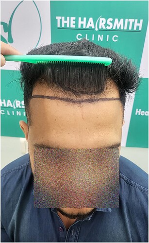 Patient Norwood stages 3 - Before  Picture (2) - The Hairsmith Hair Transplant Clinic