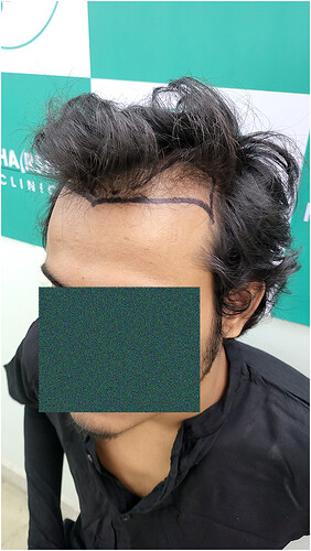 Patient Norwood stages 2 - Before  Picture 4 - The Hairsmith Hair Transplant Clinic