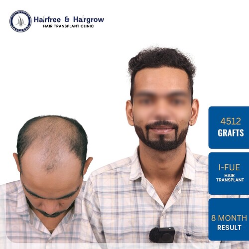 hair-transplant-4512-grafts-8-month-result-pune.jpg (1)