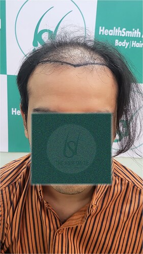 Patient Norwood stages 7 - Before  Picture 1 - The Hairsmith Hair Transplant Clinic