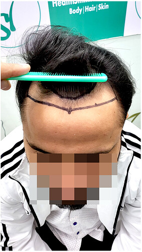 Before Hair Transplant HS 828- The Hairsmith Clinic Delhi India - 2