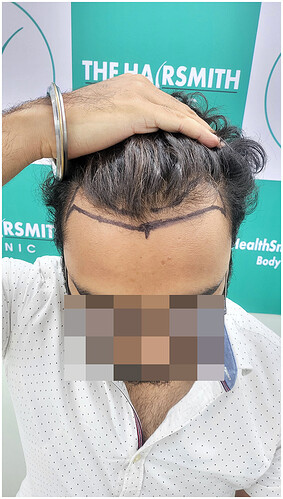 Before Hair Transplant - Norwood Stage 2 - photo 3- The Hairsmith Clinic