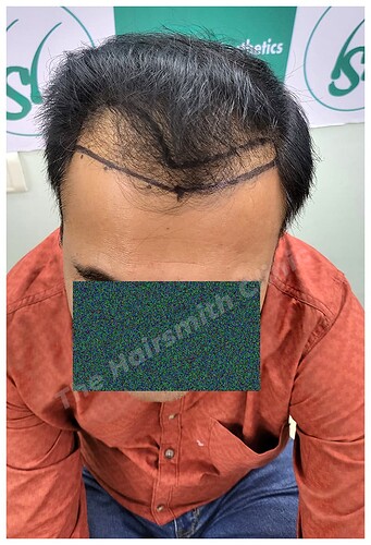 Before Hair Transplant Picture - The Hairsmith Clinic E