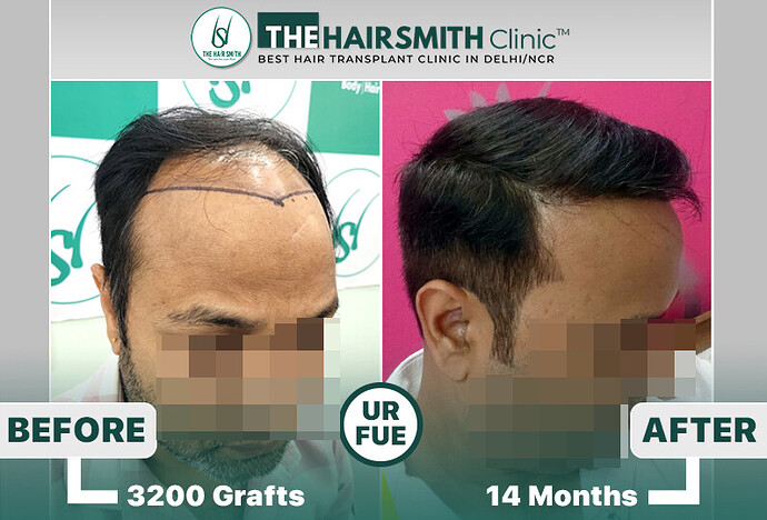 the hairsmith clinic hair transplant result #hairtransplant #hairsmithhairtransplantcost