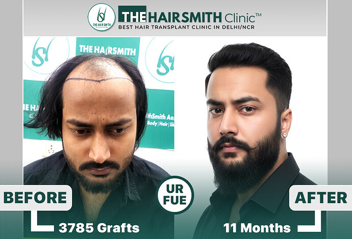 11 months hairsmith hair transplant result - the hairsmith clinic delhi