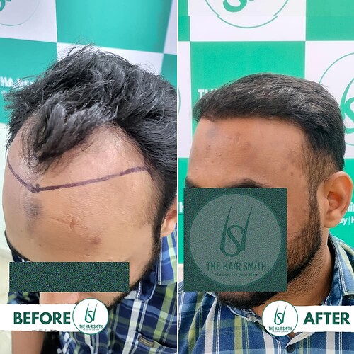 Hairline Hair Transplant Result 3 from The Hairsmith Hair Transplant Clinic