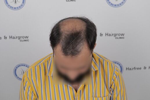 before hair transplant