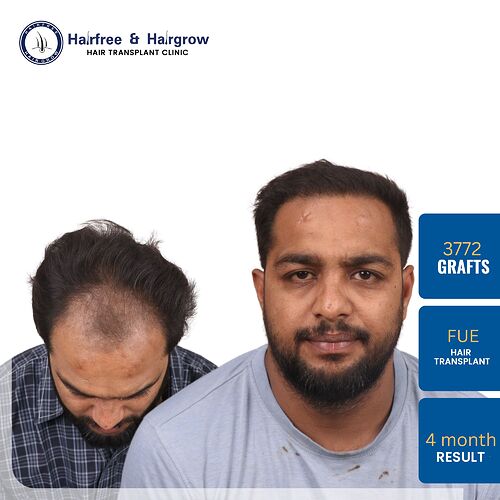 hitesh-chandrani-hair-transplant-result-3772-grafts.jpg