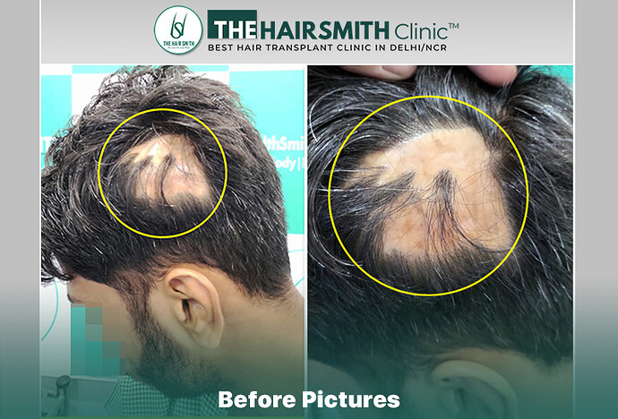 Before Image - The Hairsmith Clinic Delhi India