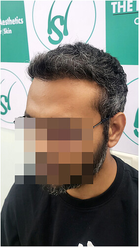 Hair Transplant Result - After 06 Months -  photo 5 - The Hairsmith Clinic