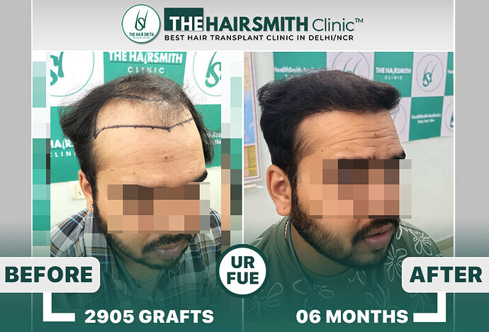 6 months hairsmith hair transplant result - The Hairsmith Clinic - #HairTransplant #The HairmsithClinic #URFUEHairTransplant