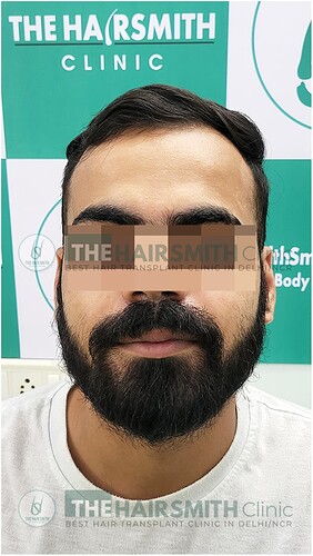 After Beard Transplant Result - 08  Months - The Hairsmith Clinic Dlehi NCR India - 1