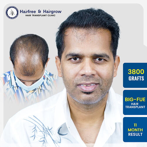 pawan-singh-3800-grafts-fue-hair-transplant-11-month-result-pune.jpg