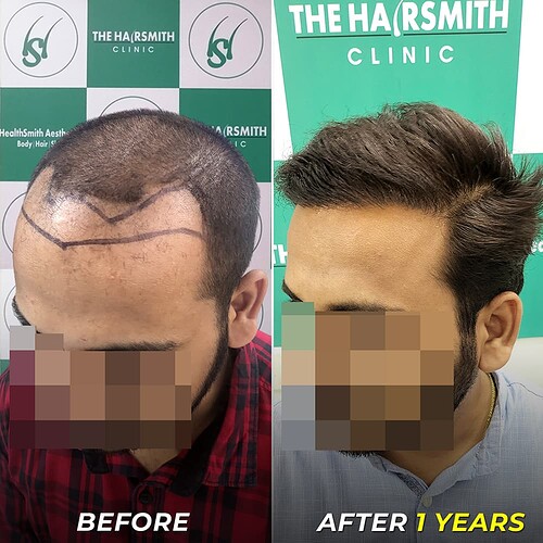 Hair Transplant Result After - 1 Years - The Hairsmith Clinic Delhi (4)