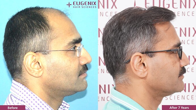hair-transplant-before-after-4