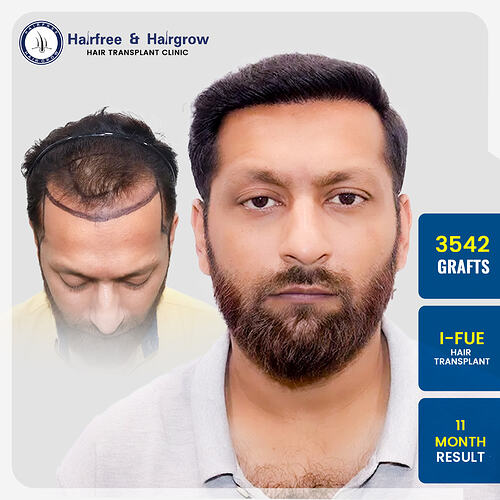 akram-tailor-hair-transplant-result-pune-india-3542-grafts-i-fue-11-months.jpg