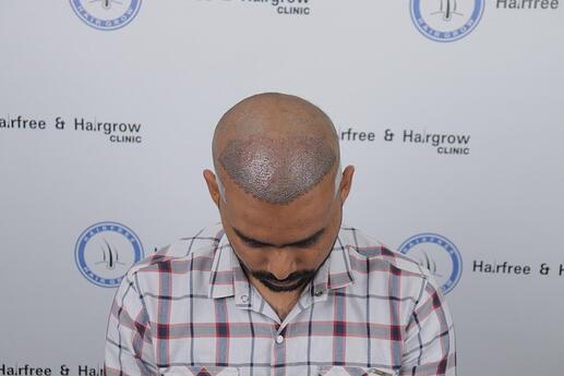 after transplant immediate photo