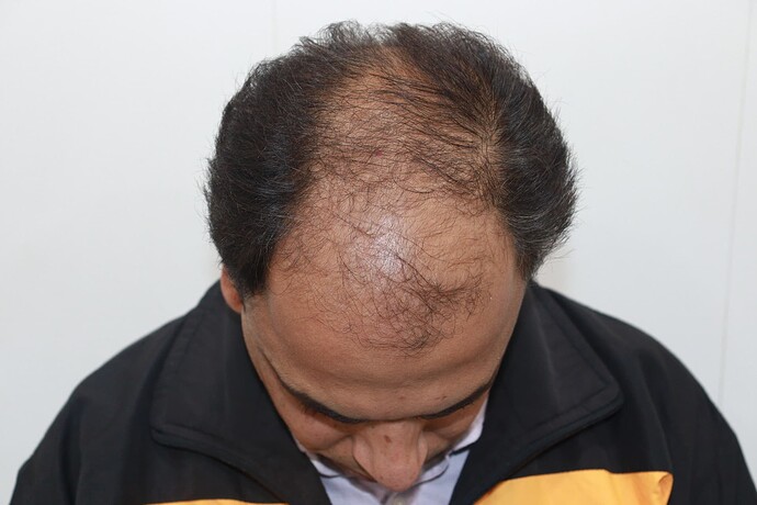 before transplant