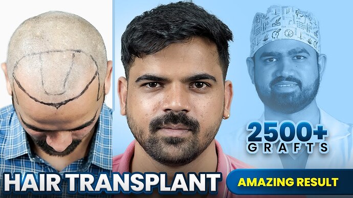 2800 Grafts Hair Transplant