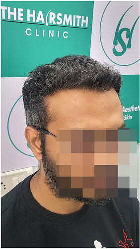 Hair Transplant Result - After 06 Months -  photo 4 - The Hairsmith Clinic