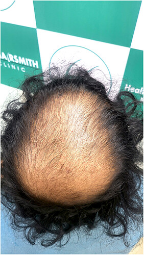 Before Hair Transplant HS 822- The Hairsmith Clinic Delhi India (3)