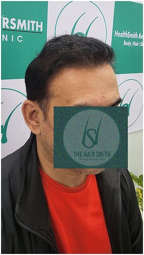 After Hair Transplant Result (5) in India  form The Hairsmith Hair Transplant Clinic