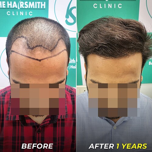 Hair Transplant Result After - 1 Years - The Hairsmith Clinic Delhi (2)