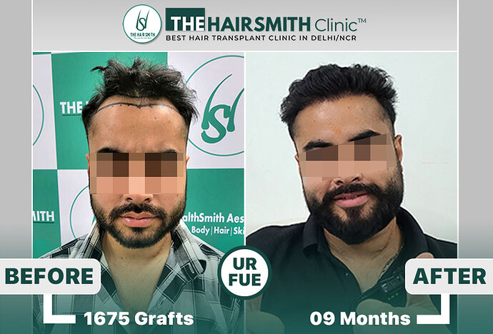 best hair transplant results in india - the hairsmith clinic