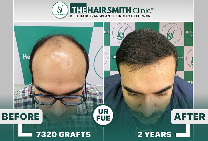 The Hairsmith Clinic Hair Transplant Results #BestHairTransplantResults #HairTransplantResult