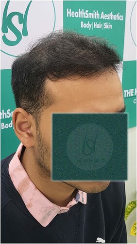 After Hair Transplant Result (3)  in India form The Hairsmith Clinic