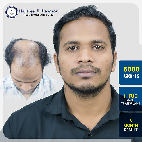 sanket-malvankar-5000-grafts-i-fue-hair-transplant-8-month-result-pune.jpg