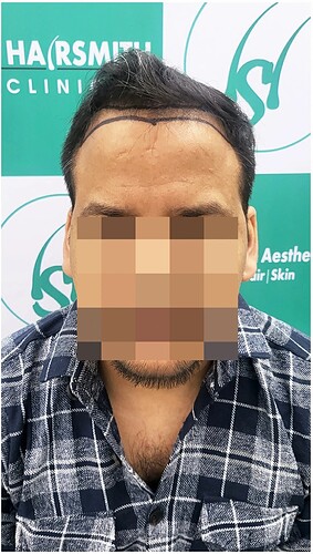 Before Hair Transplant HS 816 - The Hairsmith Clinic Delhi India - (1)