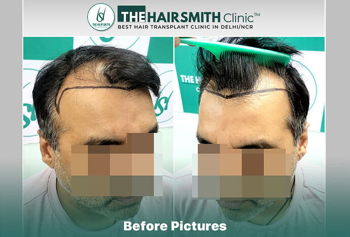 Before Hair Transplant HS 832- The Hairsmith Clinic Delhi India - 2