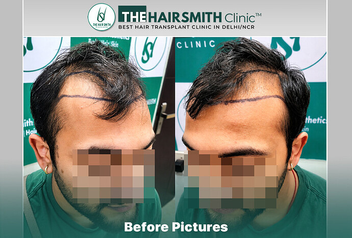Before Hair Transplant HS 842- The Hairsmith Clinic Delhi India - #hairtransplant #besthairtransplantclinic