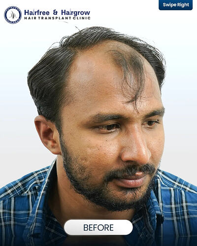 8 Years After Hair Transplant- Still Natural. A hair transplant is not just about immediate res (4)