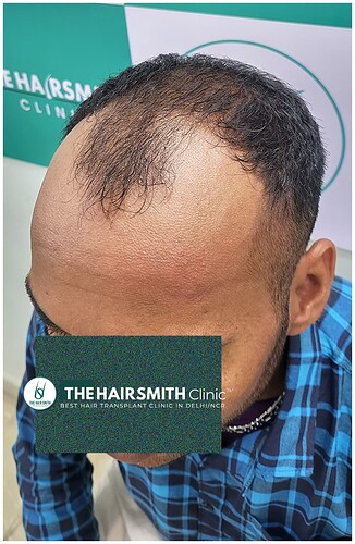 Before Hair Transplant Picture 4 - The Hairsmith Clinic