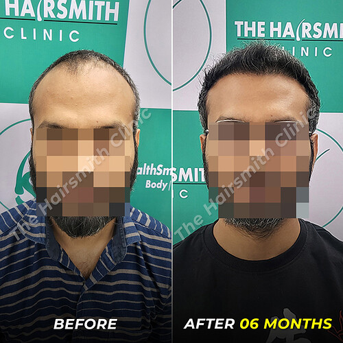 Hair Tarnsplant Befoe and After Result - photo 1 - The Hairsmith Clinic