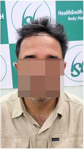 Before Hair Transplant Picture 1 - The Hairsmith Clinic