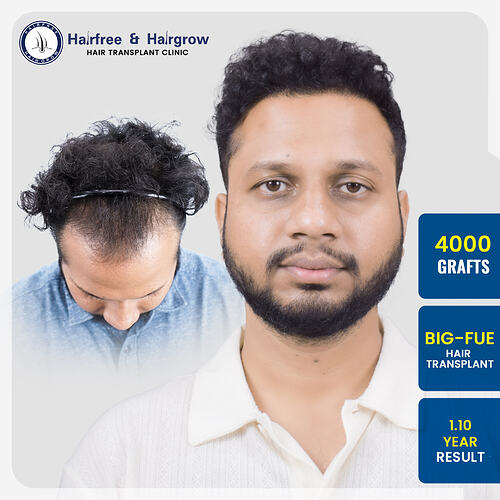 pankaj-walekar-4000-grafts-big-fue-hair-transplant-1-10-year-result-pune.jpg
