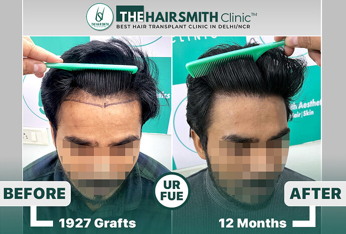 #urfuehairtransplant #hairtransplantresult #besthairtransplantdelhi #thehairsmithclinic