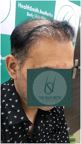 Patient Norwood stages 7 - Before  Picture 4 - The Hairsmith Hair Transplant Clinic