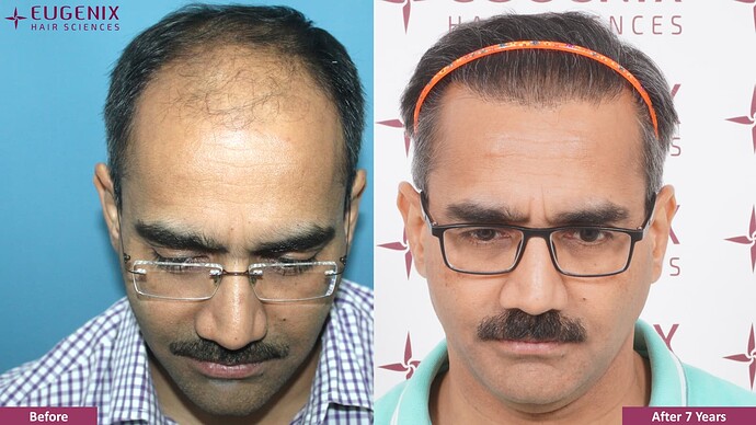 hair-transplant-before-after-2