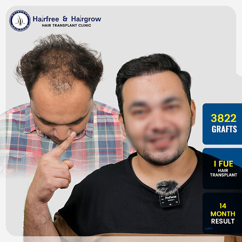 Azaz Shaikh Hair Transplant Result – 3822 Grafts FUE  14 Months Pune