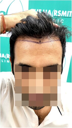 Before Hair Transplant HS 825- The Hairsmith Clinic Delhi India - (2)