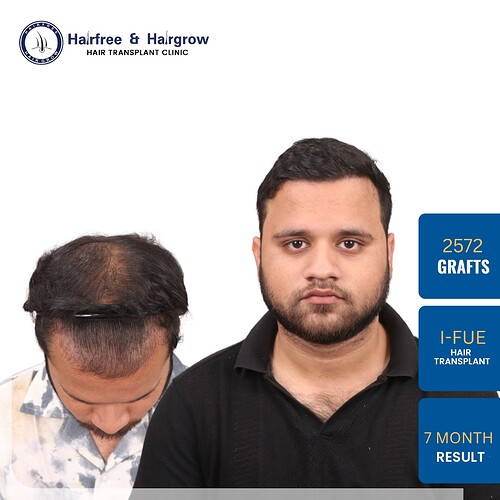2572 Grafts Hair Transplant Result After 7 Months in Pune