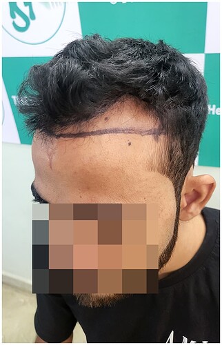 Before Hair Transplant HS 815 - The Hairsmith Clinic Delhi India - (3)