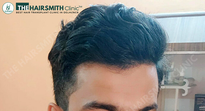 After Hair Transplant - 06 Months Update - Image 2 - The Hairsmith Clinic